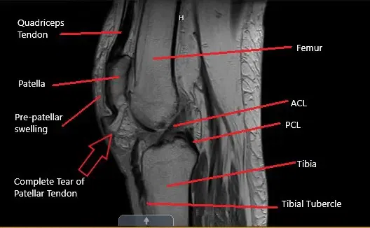 Resonancia magnética de la rodilla en la sección sagital que muestra una rotura completa del tendón rotuliano.