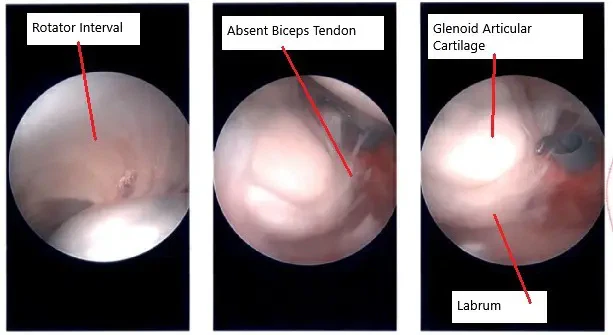 Intraoperative arthroscopic image of the shoulder.