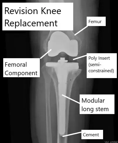 Revisión de reemplazo de rodilla que muestra el uso de componentes semi-restringidos.