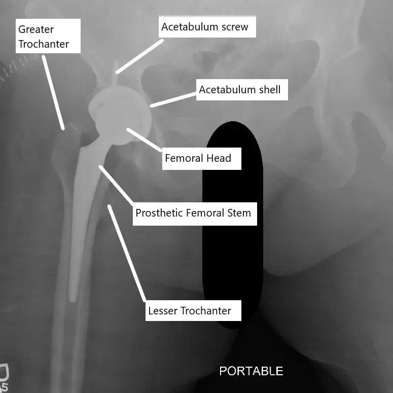 X-ray showing total hip replacement.