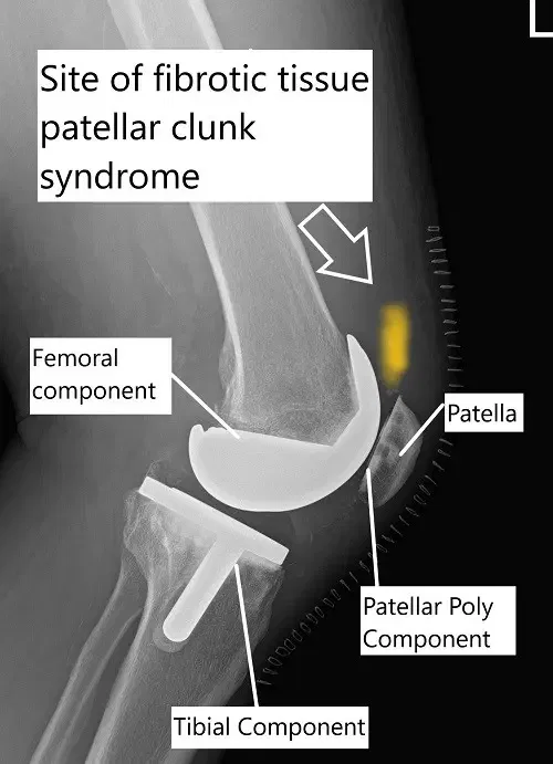 Radiografía que muestra reemplazo total de rodilla y el sitio de tejido fibroso en el síndrome de la rutela rotuliana.