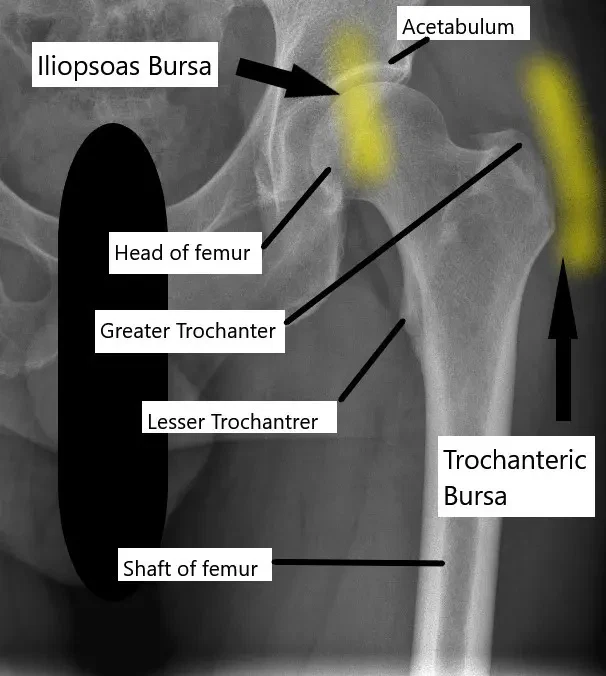 Radiografía de la articulación de la cadera y su relación con la bursa trocantérica y la bursa iliopsoas.