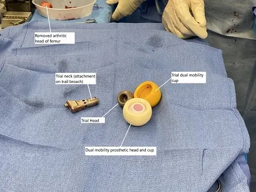 Imagen intraoperatoria que muestra un sistema de copa de doble movilidad utilizado para mayor estabilidad y prevención de dislocaciones.