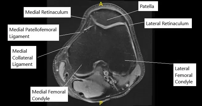 La resonancia magnética de rodilla en la sección axial mostró un MPFL normal.