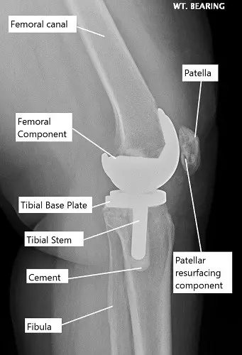 La radiografía muestra un reemplazo total de rodilla.