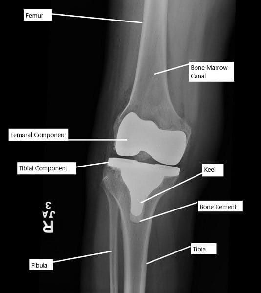 X-ray showing a total knee replacement.