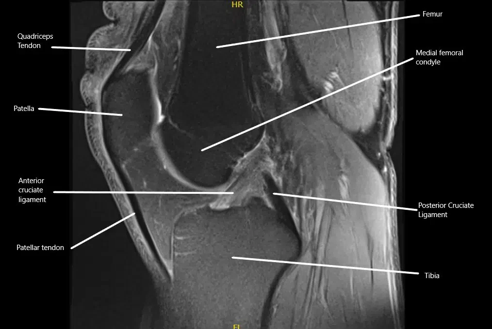 MRI showing the normal cruciate ligaments in the knee joint in the sagittal section.