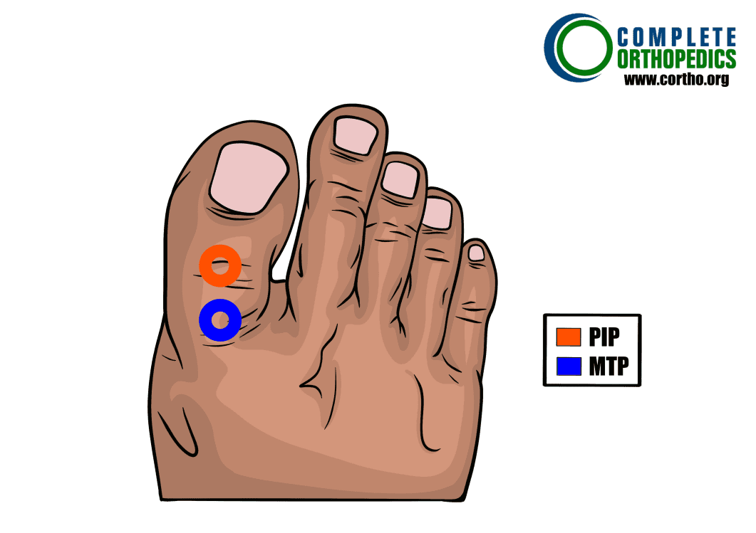 Great-Toe metatarsophalangeal joint and proximal interphalangeal joint to evaluate loss of motion to calculate scheduled loss of use for workers compensation patient