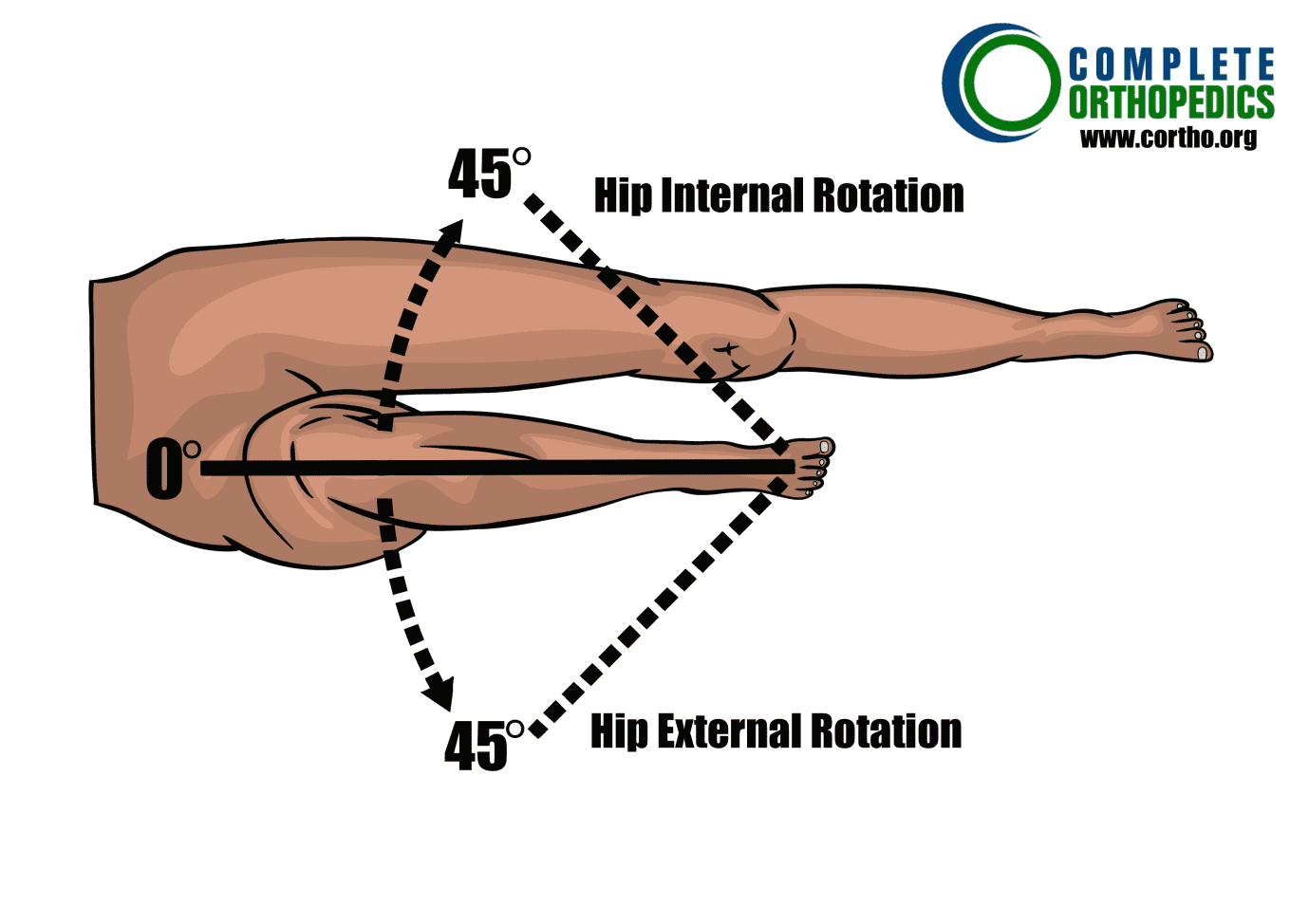 Hip external and internal rotation to evaluate loss of motion to calculate scheduled loss of use for workers compensation patient