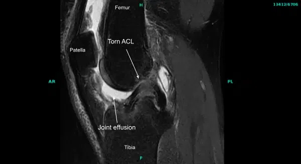 MRI of the right knee joint