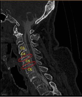 Cervical Spondylotic