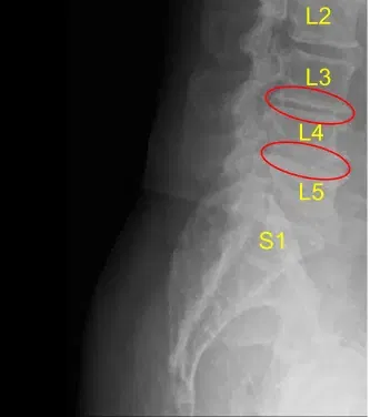 Disc space narrowing at L3-L4 and L4-L5