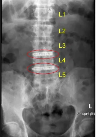 Radiografía postoperatoria