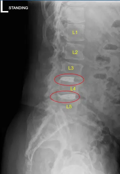 Vista sagital postoperatoria por rayos X