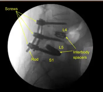Laminectomy and Fusion sample (3)