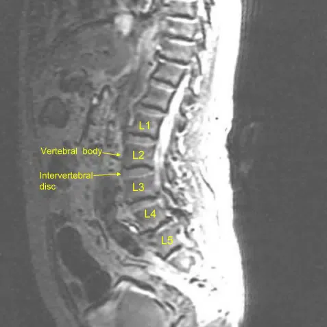 Vista sagital de la resonancia magnética lumbar preoperatoria