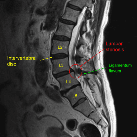 Sagittal view of pre-operative Lumbar Spine MRI