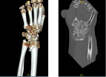 CT-Left wrist non-contrast