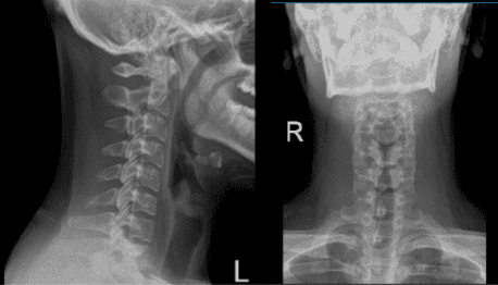 Cervical Spine X-ray 2 Views