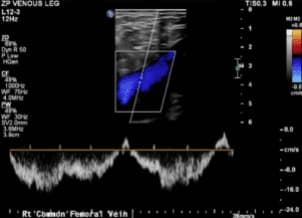 Extremidad Inferior Izquierda Veosa Doppler