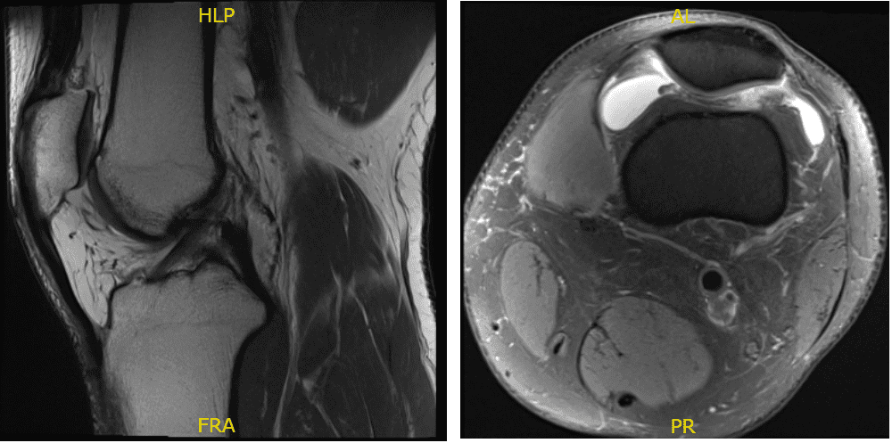 Fig. 1 Resonancia magnética de la rodilla izquierda en secciones sagital y coronal. 