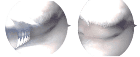 Intraoperative Arthroscopic images taken during operation