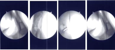 Imágenes de artroscopia intraoperatoria