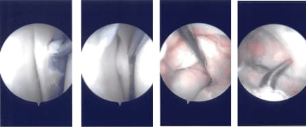 Imágenes de artroscopia intraoperatoria