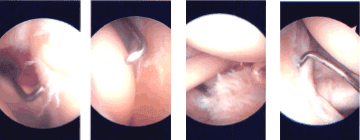 Imágenes de artroscopia intraoperatoria