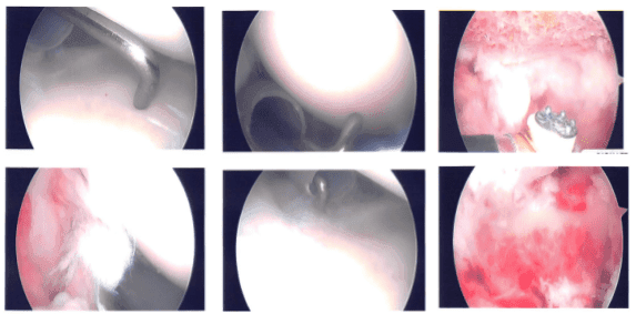 Foto intraoperatoria