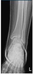 Left Ankle X-Ray complete 3 or more views