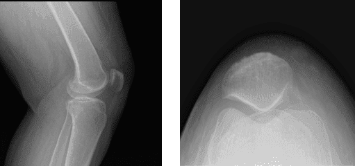 Radiografía de la rodilla izquierda completa con rótula