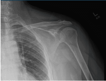 Left Shoulder X-ray