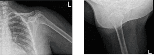 Radiografía del hombro izquierdo