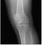 Radiografía de rodilla izquierda AP y lateral con vistas oblicuas