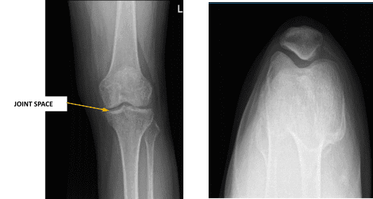 Radiografía de rodilla izquierda con rótula