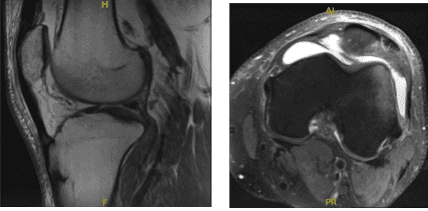 MRI - 3T Left Knee Non Contrast