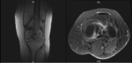 MRI-3T Rodilla Izquierda sin contraste