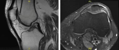MRI-3T Rodilla Izquierda sin contraste
