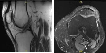 MRI-3T Rodilla Izquierda sin contraste