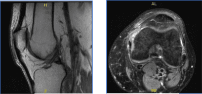 MRI-3T Rodilla Izquierda sin contraste