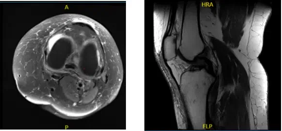 MRI-3T Rodilla Izquierda sin contraste