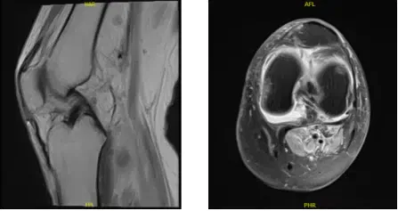 MRI-3T Rodilla Izquierda sin contraste