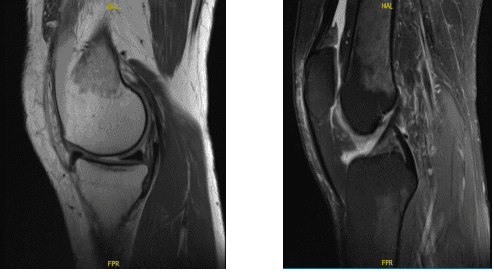 MRI-3T Left knee non-contrast
