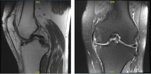 MRI-3T Rodilla izquierda sin contraste