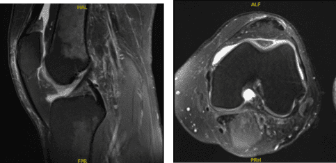 MRI-3T Left knee non-contrast