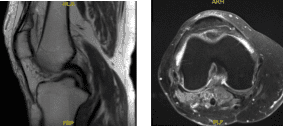 Resonancia - 3T rodilla derecha sin contraste