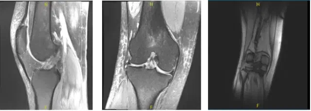 MRI-3T Right Knee non-contrast