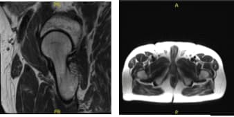 MRI-3T cadera derecha sin contraste
