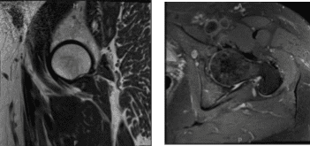 Resonancia magnética 3T sin contraste en la cadera izquierda